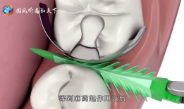 拔牙视频全过程,拔牙手术的惊心动魄瞬间